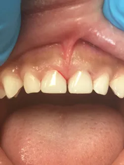 Patient 1 after treatment