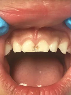 Patient 1 before treatment