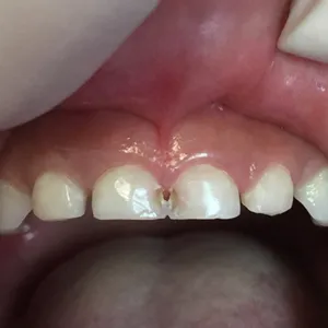 Patient 2 before treatment