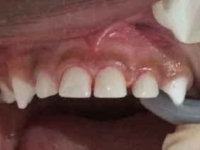 Patient 3 before treatment