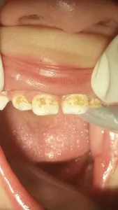 Patient 4 before treatment