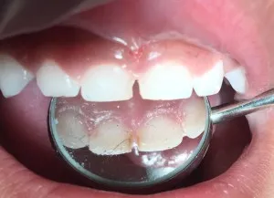 Patient 5 before treatment