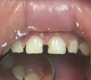 Patient 8 before treatment