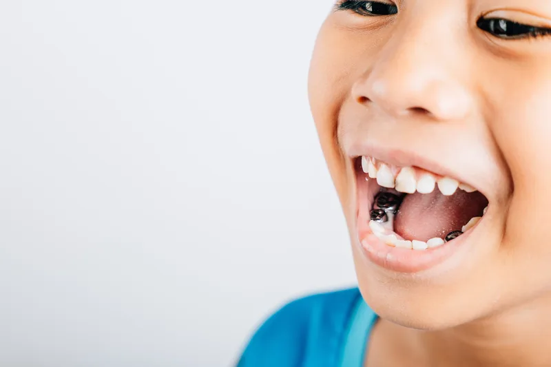 Pediatric dentist preparing to place a baby-tooth crown